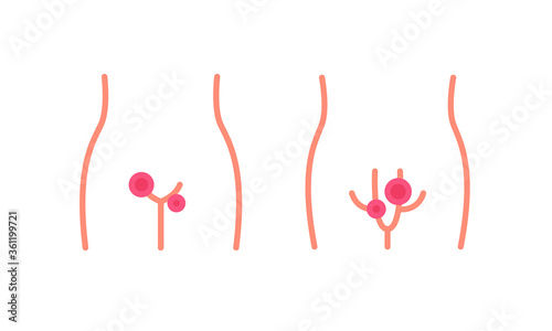 genital herpes flat icon, vector color illustration photo
