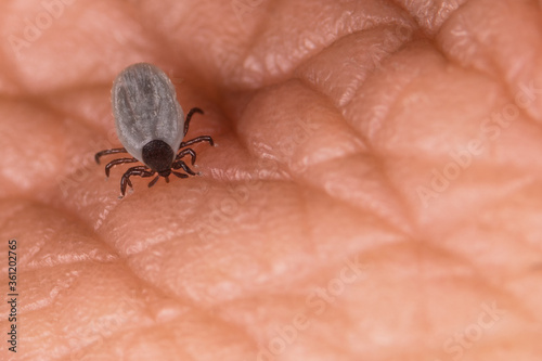 Biting castor bean tick with hypostom penetrating a skin and outstretched palps. Ixodes ricinus. Small female parasitic mite when piercing human epidermis. Fattened parasite body. Tick-borne diseases.