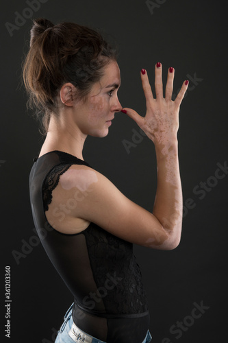 Vitiligo on the hands. Young beautiful woman with vitiligo.