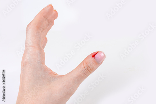 Bleeding hangnail closeup female hand injury. Bad habits, biting and ripping off hangnails on fingernails photo