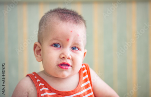 Baby eaten by mosquitoes.New born with multiple mosquito bites Allergy to insect bites Unrecognizable.Mosquito bite on the face. photo