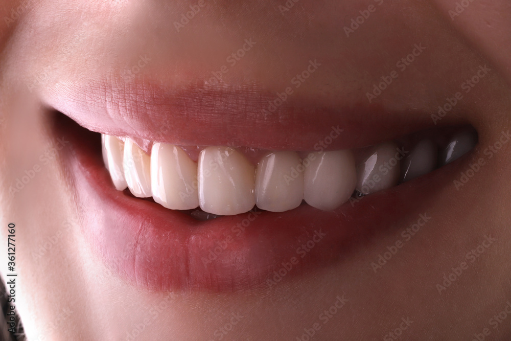 Obraz premium Perfect healthy teeth beautiful wide smile bleaching procedure whitening of young smiling attractive sexy lips woman. Dental restoration treatmentClose Up oral care dentistry, stomatology Dentistry