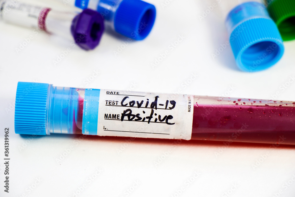 Corona virus positive test samples. Diagnosis and laboratory. Studio shoot, white background. Corona virus positive test samples. Diagnosis and laboratory. Studio shoot, white background.