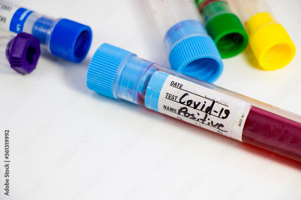 Corona virus positive test samples. Diagnosis and laboratory. Studio shoot, white background. Corona virus positive test samples. Diagnosis and laboratory. Studio shoot, white background.