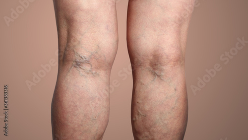 The varicose veins on a legs of woman photo