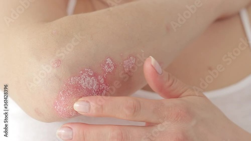 Woman hands scratch acute psoriasis on the elbows, which is an autoimmune incurable dermatological skin disease.