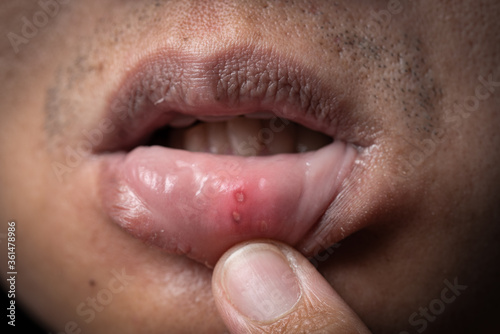 Close up mouth of asian man with aphthous stomatitis photo