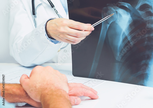 Female doctors hand pointing at x-ray medical imaging with a shoulder condition. Bone health  impingement. Orthopedics medicine. Healthcare and medicine.