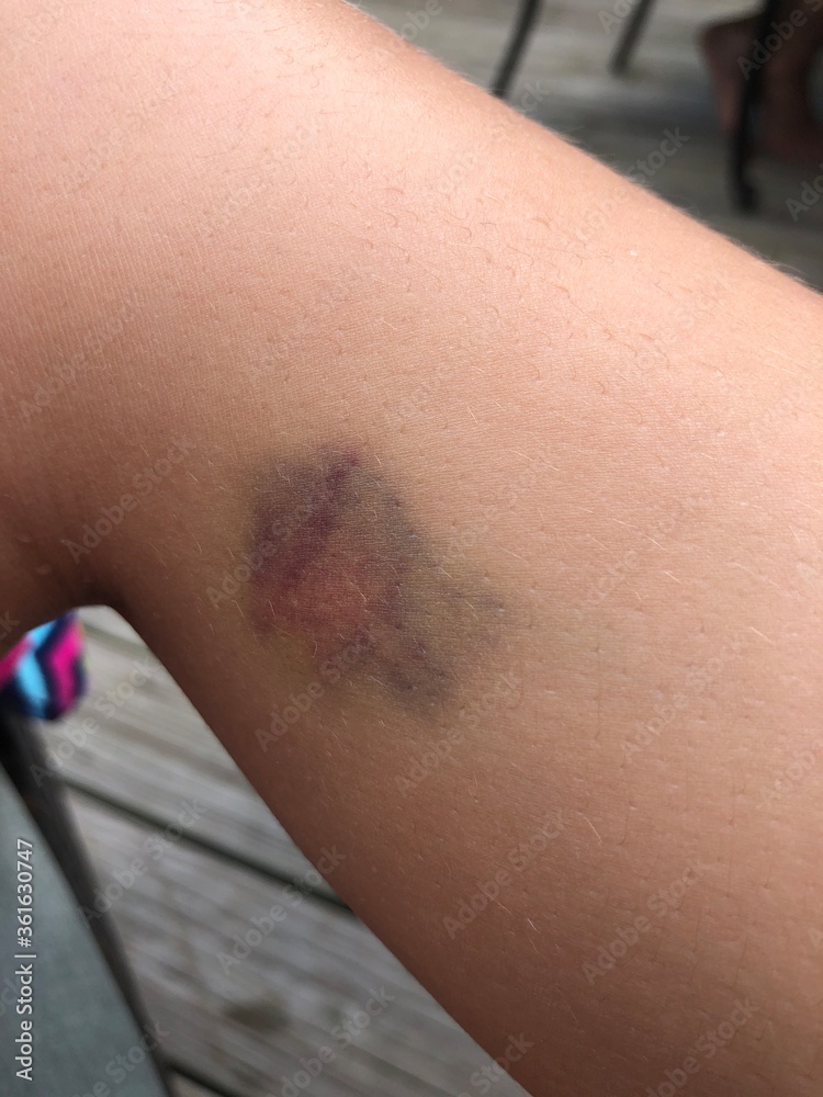 Black and blue bruise contusion on child's leg Stock Photo Adobe Stock