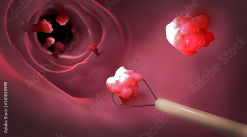 Removal of a colonic polyp with a electrical wire loop during a colonoscopy - 3d illustration photo