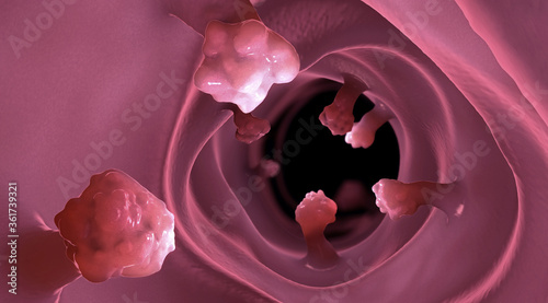 Close-up view of intestinal polyps and diseased intestinal tissue that can cause cancer - 3d illustration photo