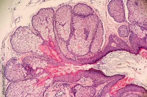 Foto Hyperplastic sebeceous Glands of the Skin surrounding a dilated follicle
