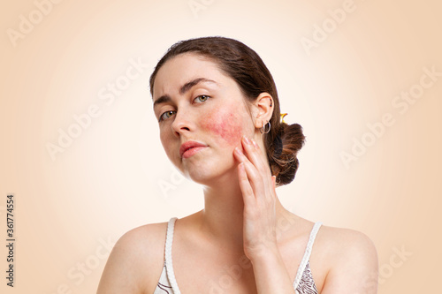 Portrait of a young pretty Caucasian woman who frowns and shows reddened and inflamed cheeks. Beige background. Copy space. The concept of rosacea, healthcare and couperose photo