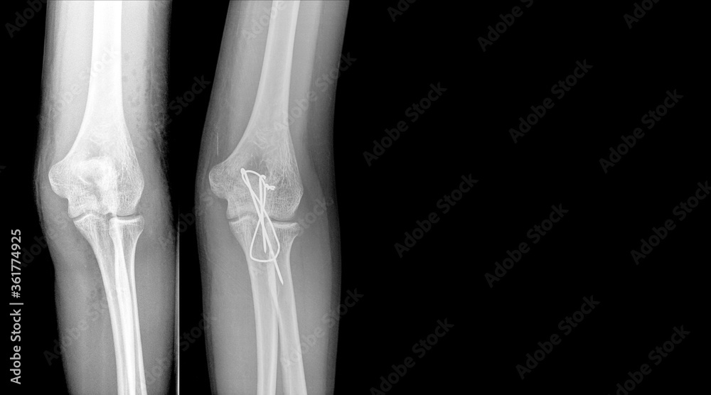 X-ray elbow showing fracture (proximal Ulna or Olecranon fracture) treated by surgery with tension band wiring fixation(TBW). Highlight on medical instrument.Medical healthcare concept. X-ray elbow showing fracture (proximal Ulna or Olecranon fracture) treated by surgery with tension band wiring fixation(TBW). Highlight on medical instrument.Medical healthcare concept.