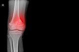 Knee joint x-ray  showing  fracture distal femur on red mark.and black background.