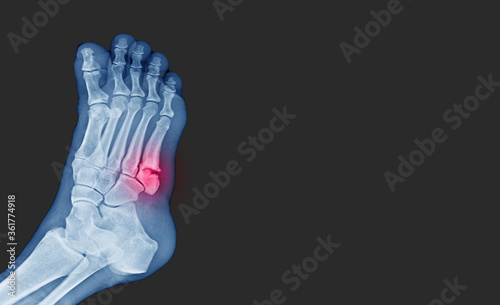 X-ray foot showing  toe 5th bone fracture ( base of metatarsal fracture ) from against the wall. Highlight on fracture site and painful.Medical healthcare concept.