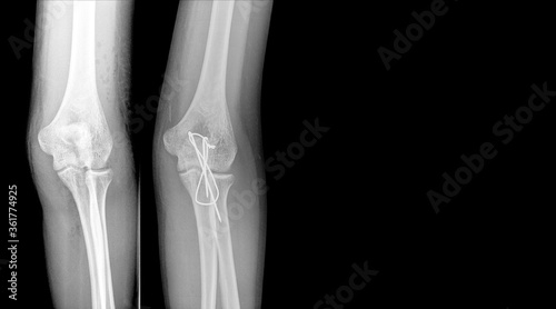 X-ray elbow showing fracture (proximal Ulna or Olecranon fracture) treated by surgery with tension band wiring fixation(TBW). Highlight on medical instrument.Medical healthcare concept.