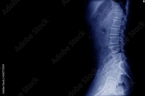 X-ray lumbo-sacral spine and pelvis No fracture, dislocation , bony destruction Normal joint space finding Aseptic necrosis.