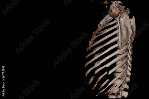 CT Scan Thoracic spine 3D finding The film shown thoracolumbar fracture injury after fall form height . photo