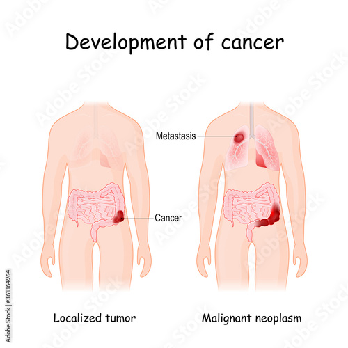 Cancer development. colon cancer and metastasis in lungs photo