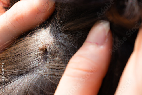 Girl removing big tick with hands, that was sucking blood from dog Border collie, hidden by the fur of the dog.