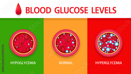 Hyperglycemia, High Blood Sugar and Diabetes ,obesity is a serious medical condition causes, vector design.