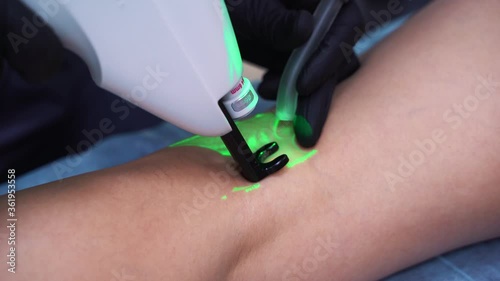 A doctor does medical procedure Sclerotherapy used to eliminate varicose veins and spider veins. An injection of a solution directly into the vein.