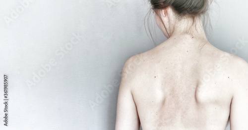 Young woman turned away to white wall, showing unhealthy back with scapular winging. Caucasian naked female with brown hair. Health care of spine, back and shoulder blades. Check up at hospital clinic photo