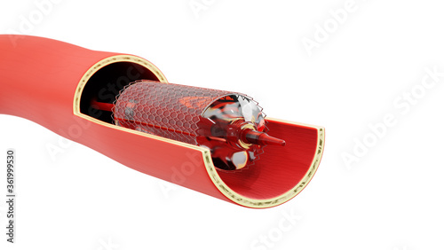 Fényképezés Stent implantation for supply blood to the heart
