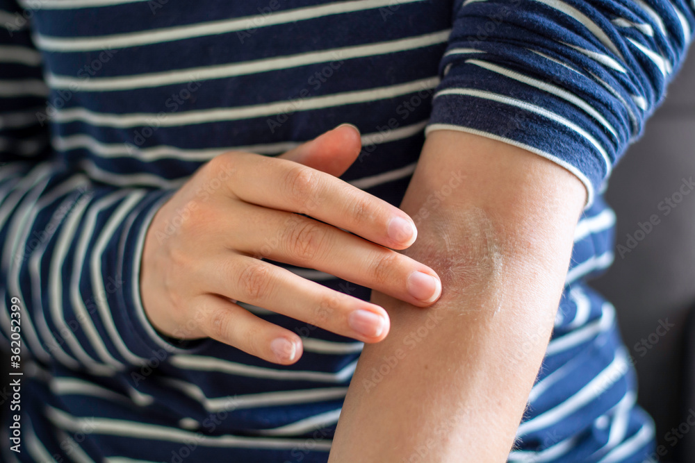 Female hands applying ointment on crook of arm / elbow. Apply a
