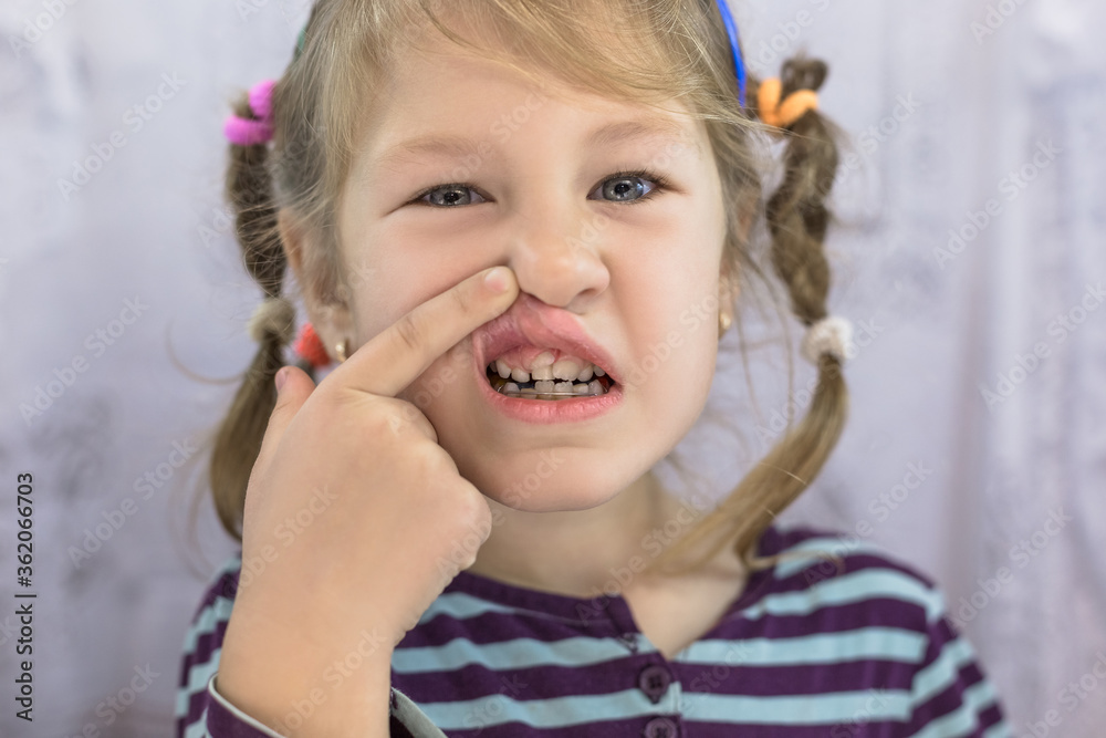 Adult Permanent Teeth Coming In Front Of The Child's Baby Teeth: Shark ...