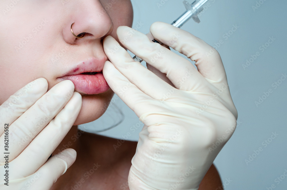 Beautiful woman with a bruise on her lips after lip augmentation with