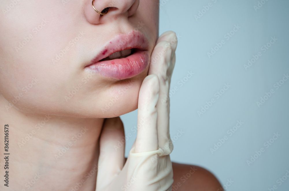 Beautiful woman with a bruise on her lips after lip augmentation with