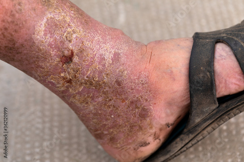 Foot ulcer photo