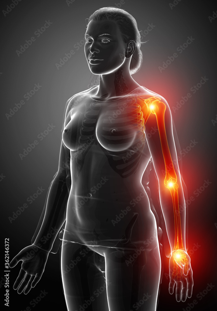3d Illustration of Female arm joint pain