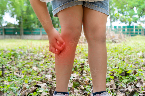 Asian girl has allergies with mosquitoes bite and itching her leg. Repellent, Dengue virus, Yellow fever, West nile, Malaria, Diseases Spread by Mosquitoes concept photo