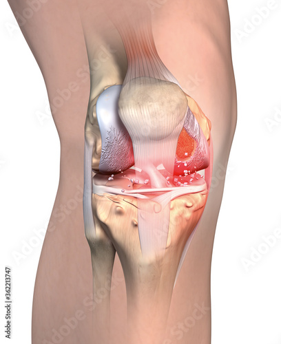Rheumatoid arthritis of the knee, medical accurate illustration