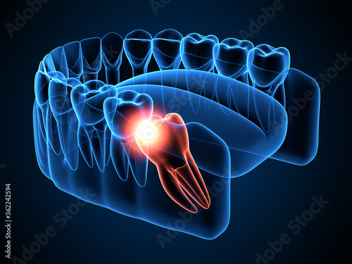 3d render of jaw x-ray with wisdom mesial impaction photo