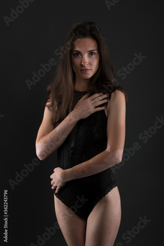 Portrait of beautiful woman with vitiligo.