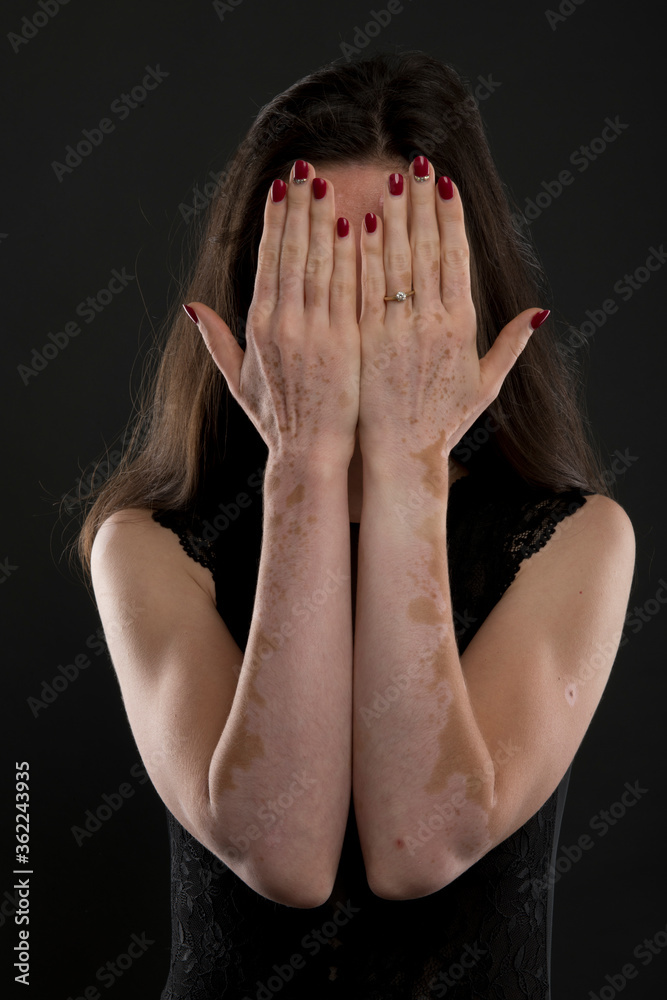 Portrait of beautiful woman with vitiligo. Portrait of beautiful woman with vitiligo.