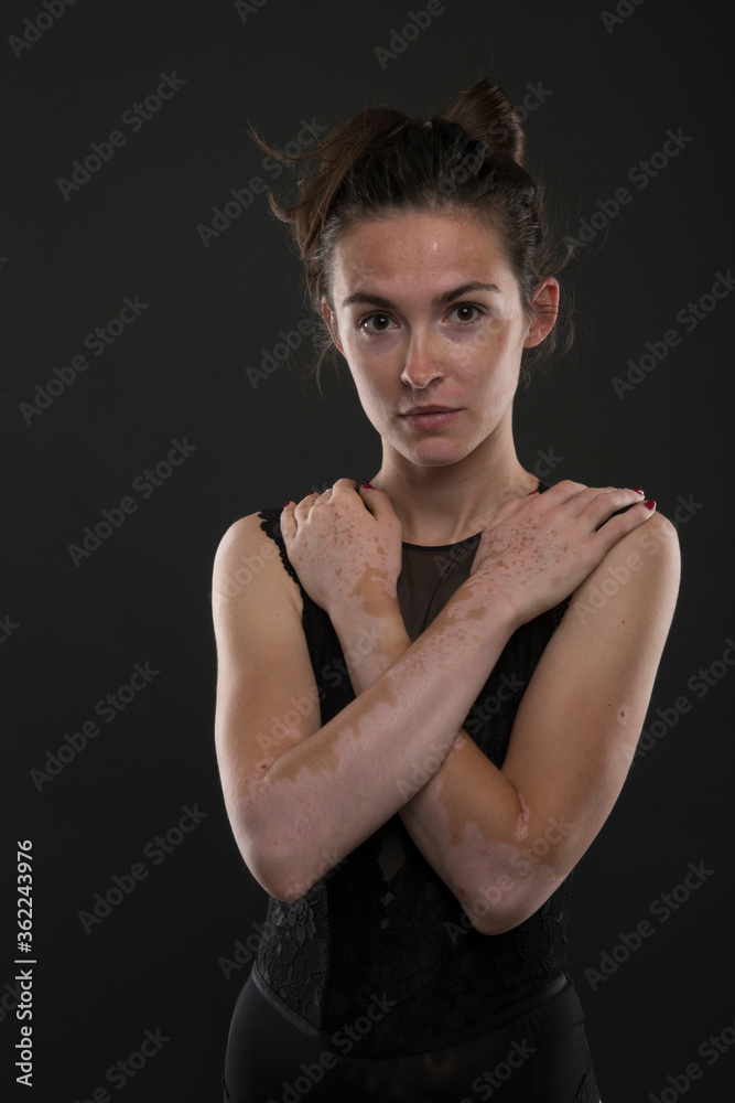 Portrait of beautiful woman with vitiligo.