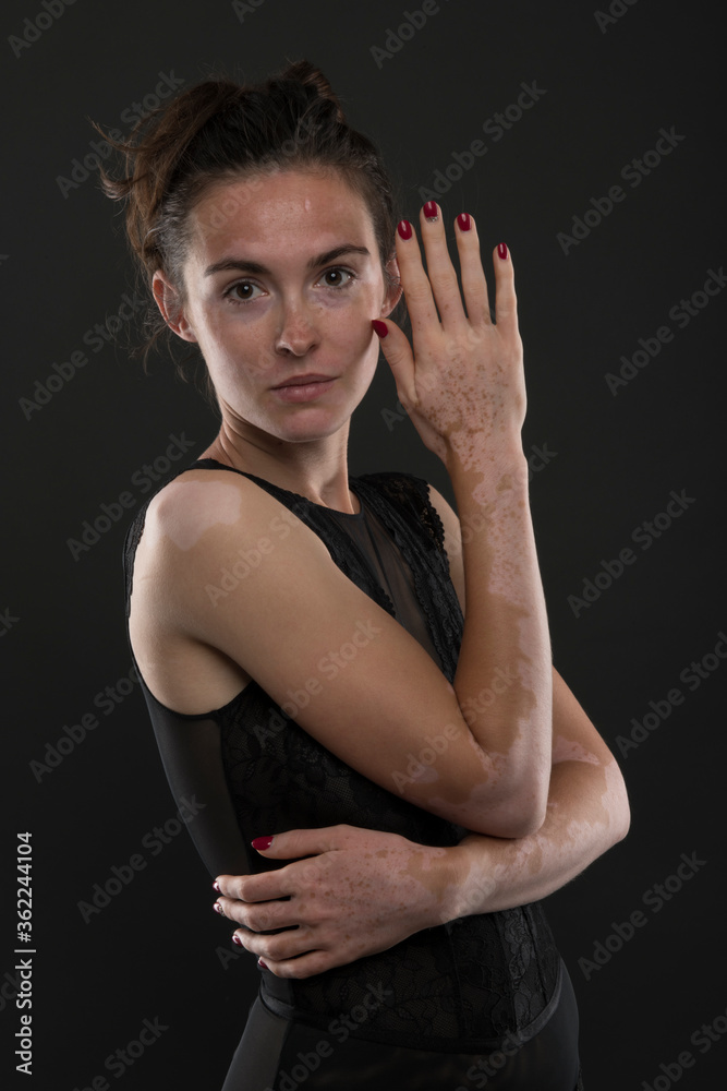 Portrait of beautiful woman with vitiligo. Portrait of beautiful woman with vitiligo.