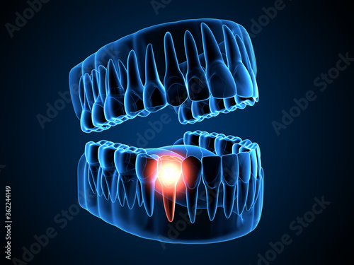 Foto 3d render of  jaw x-ray with  throbbing aching premolar tooth
