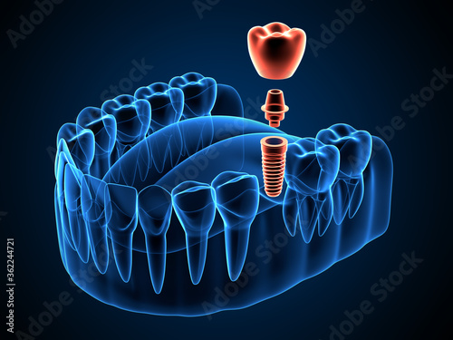 3d render of jaw x-ray  with dental implant placement photo