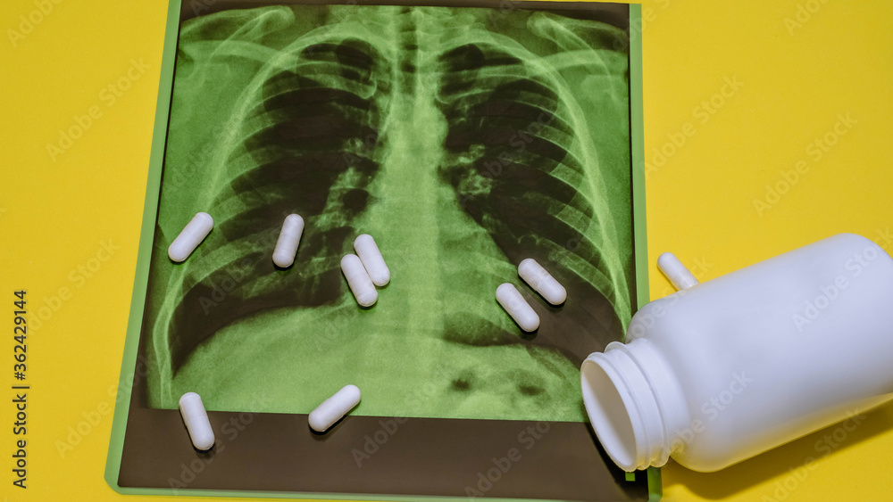 A closeup xray of the lungs,pills scattered over a picture of the lungs,a white medical jar,a