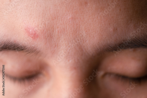 adult has skin problem with acne, pore and wrinkle.