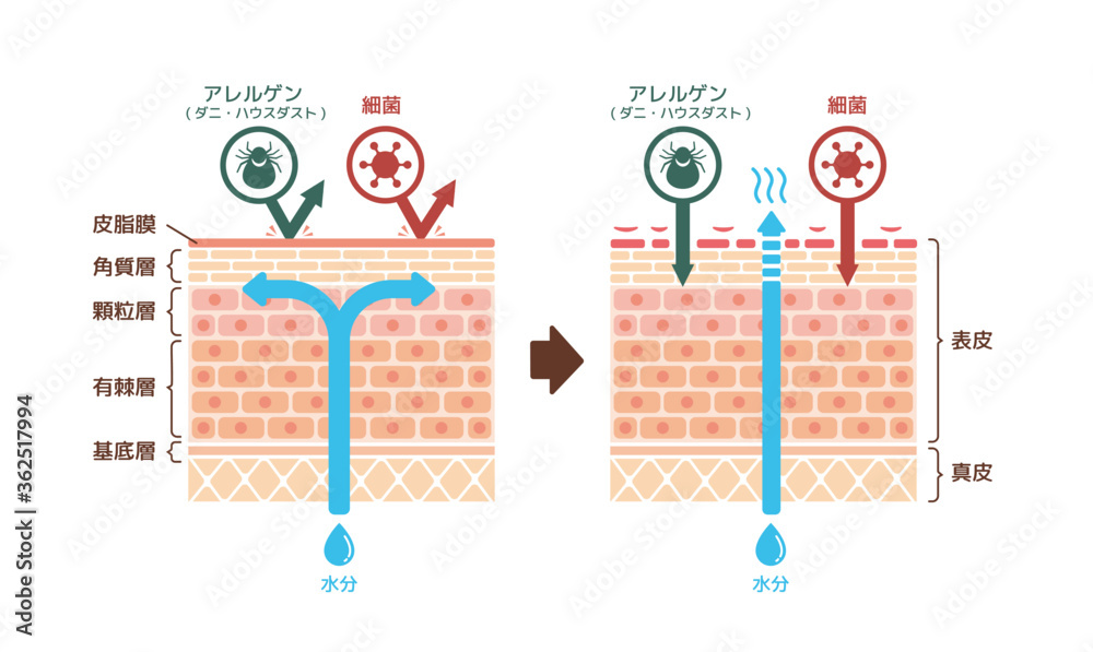 健康な皮膚とアトピー性皮膚炎 比較断面図イラスト Stock Vector Adobe Stock
