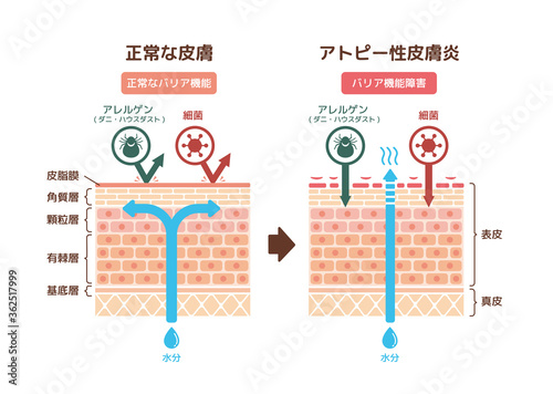 健康な皮膚とアトピー性皮膚炎　比較断面図イラスト