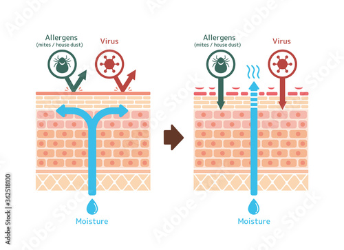 Sectional view of atopic dermatitis and normal skin / Comparative vector illustration