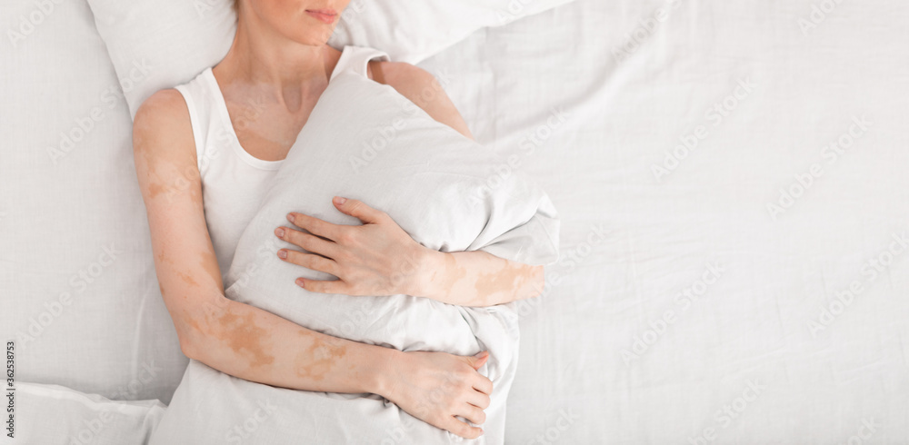 Woman with vitiligo lying in double bed and hugging pillow